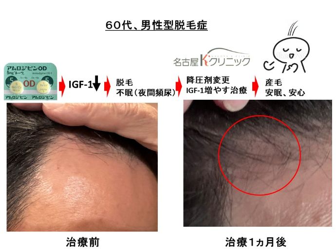 円形脱毛症　病院